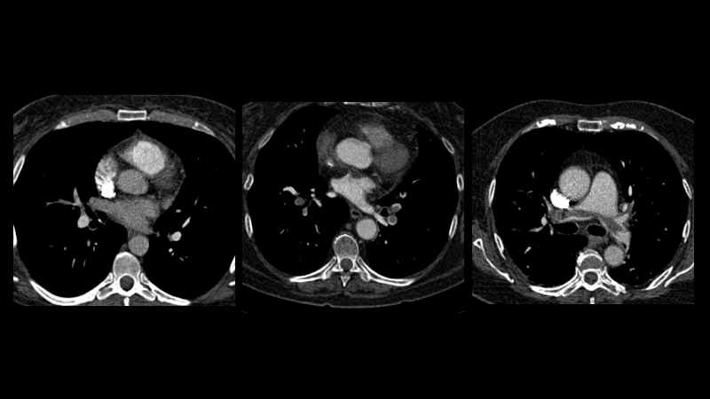 CAD-PE: Pulmonary Embolism Detection