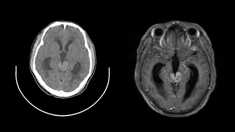 Germinoma CT/MRI Dataset