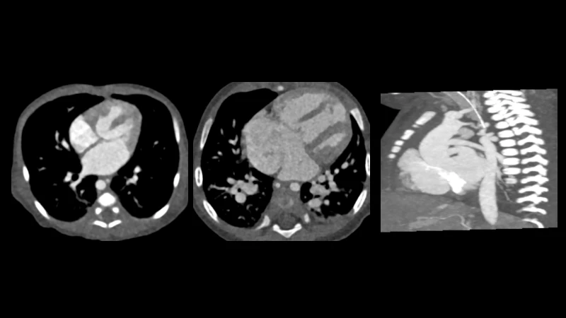 ImageCHD: Congenital Heart Disease