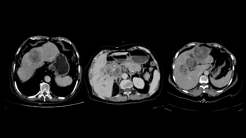 Primary Liver Cancer