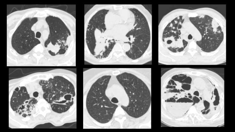 Mycobacterial CT Imaging Database