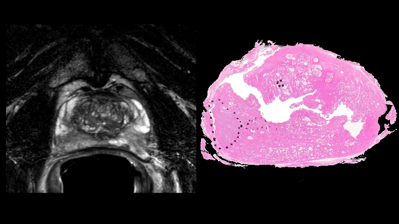PROSTATE-MRI: Prostate Cancer