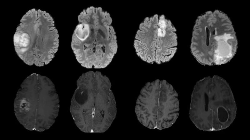 UCSF-PDGM: Diffuse Glioma